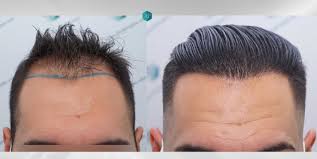 follicle thought hair growth