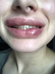 are my lip fillers infected photo