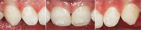For some more detailed severe fluorosis pictures, click here. Case 1 Mild To Moderate Fluorosis And Hypoplasia Related To Traumatic Download Scientific Diagram