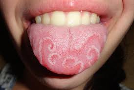 Green Tongue Causes Infections And Treatments
