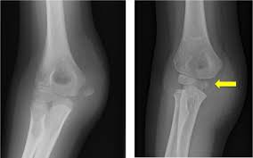 The fundamental principles of fracture care apply to medial epicondyle fractures in that the goals of treatment are to obtain fracture healing and to promote a return of appropriate motion, strength, and stability. The Elbow