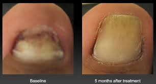 toenail fungus treatment