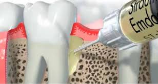 אמדוגיין EMDOGAIN ד&quot;ר גיא וולפין - להציל שיניים מעקירות למרות מחלת חניכיים 