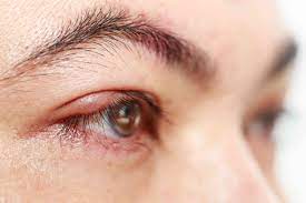how to get rid of a stye cations