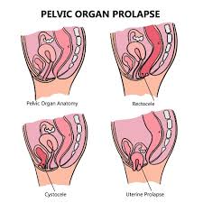 prolapse revive physical therapy