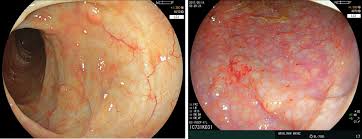Symptoms usually develop over time, rather than suddenly. Advanced Endoscopic Imaging For Diagnosis Of Inflammatory Bowel Diseases Present And Future Perspectives Sivanathan 2018 Digestive Endoscopy Wiley Online Library