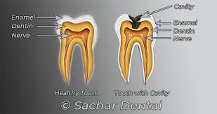 Putting dental fillings off could cost you the longer you wait to schedule that appointment for your dental filling, the more time but not everyone has dental insurance to cover an unexpected filling. Dentist Nyc Dental Cavity Fillings Sachar Dental Nyc