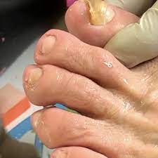 ingrown toenail removal in fremont ca
