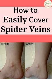 how to easily cover spider veins with
