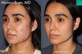 scar acne scar treatment san go