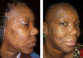 2 Skin Lightening Soap Skin Cleaning Acne Removing Works Within Two Weeks Ebay