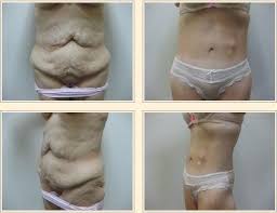 post bariatric cosmetic surgery my