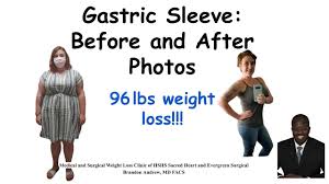 bariatric weight loss surgery journey