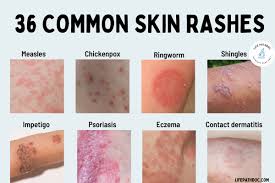 rash 36 common skin rashes pictures