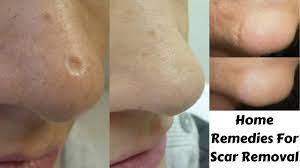 scar removal easy effective remes