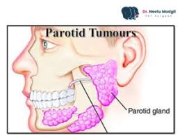 parotid tumours salivary gland tumours
