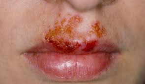 Image result for chemo sores in mouth