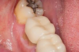 gum disease treatment kalispell