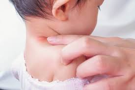 handling baby rash on neck essential