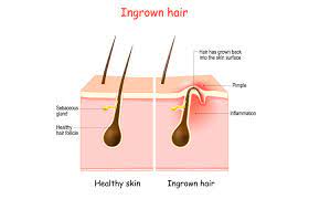 ingrown hair scars causes how to