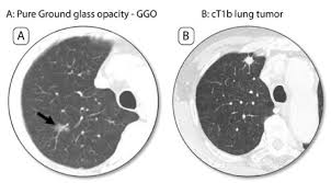 Surgery In Lung Cancer Treatment
