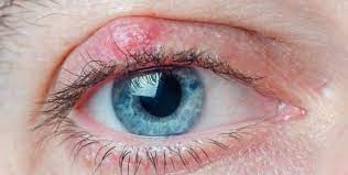 types of eyelid cysts common eye