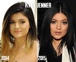 kylie jenner lips before after dr