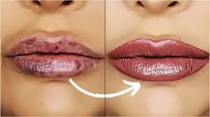 cover bruising from lip filler