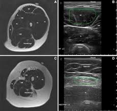 What to look for, where to look & how to report. Quantitative Muscle Mri And Ultrasound For Facioscapulohumeral Muscular Dystrophy Complementary Imaging Biomarkers Springerlink