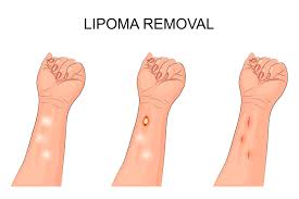 clinics for lipoma removal in spain