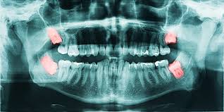 impacted wisdom tooth dentist