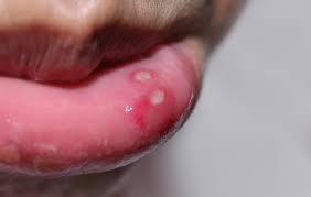 are cold sores conious how long are
