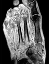 In conclusion, quantification of foot muscles enables an objective measure of motor dysfunction closely related to the severity of diabetic neuropathy. Mri Of The Diabetic Foot Radsource