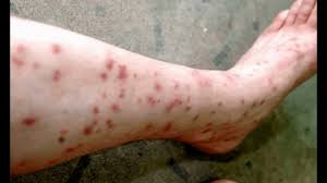 flea bites on humans pictures tsmp