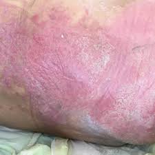 erythematous plaque on the groin and