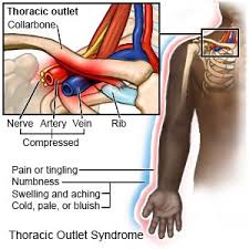 thoracic outlet syndrome what you