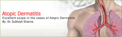 atopic dermais homeopathic treatment