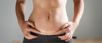 tummy tuck after a c section anca