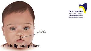 cleft lip and palate dr jamilian