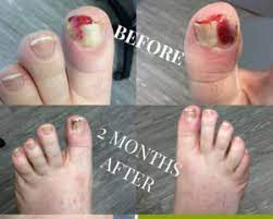 permanent ingrown toenail removal