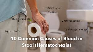 causes of blood in stool hematochezia