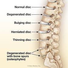 Degenerative Disc Disease aka DDD
