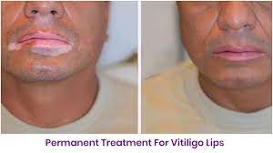 permanent treatment for vigo lips