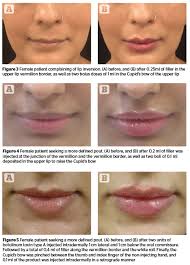 lip rejuvenation prime journal