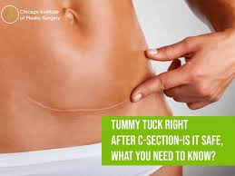 tummy tuck right after c section is it