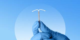 iud removal when to remove what to