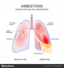 asbestosis lungs inflammation scarring