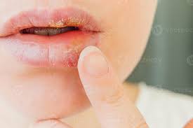 lips affected by herpes treatment