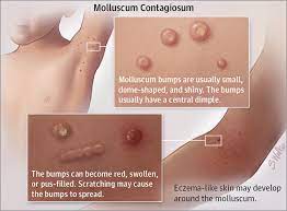 This is a very contagious disease, has a viral etiology. Cantharidin Treatment For Molluscum Durban Skin Doctor