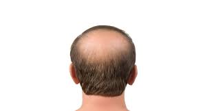 how to regrow hair on a bald spot 25